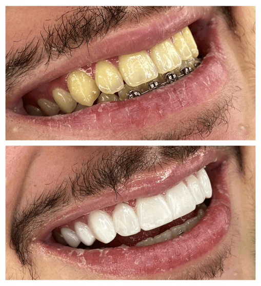 facetas dentarias sideropolis (1)