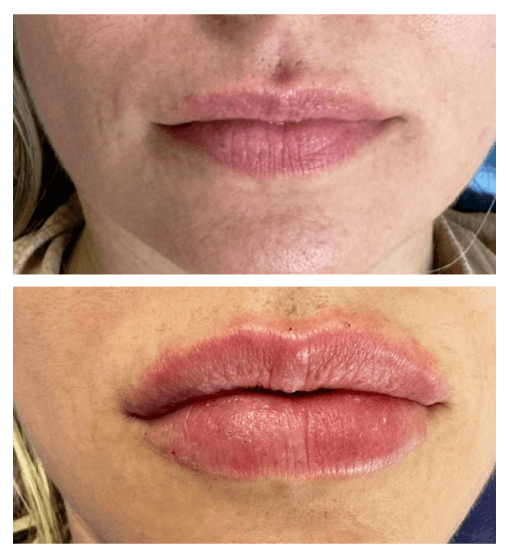 preenchimento labial sideropolis ...